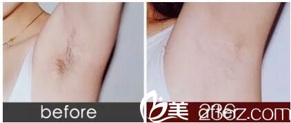 正规医院脱毛价格详解,全面解析与案例分享